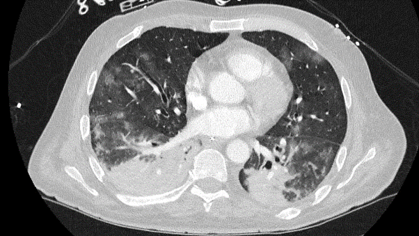 Image of a second x-ray - Extensive bilateral ground glass opacification and confluent consolidation