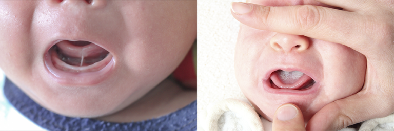 Two images show examples of oral thrush on the newborn tongue (pictured right) and ankyloglossia, also known as 'tongue tie' (pictured left)