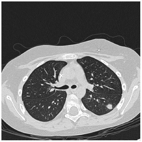 HRCT-thorax showing a dense nodule in periphery of left lung
