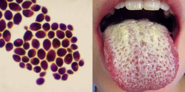 Left: Microscope image of Candida albicans. Right: Tongue showing Candida albicans