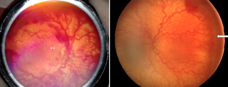 Two retinal photographs side by side illustrating the differences between APROP and Stage 3 ROP with plus disease as described above