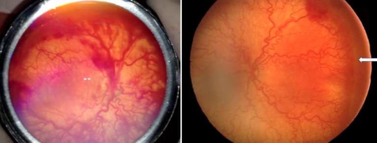 retinopathy of prematurity plus disease