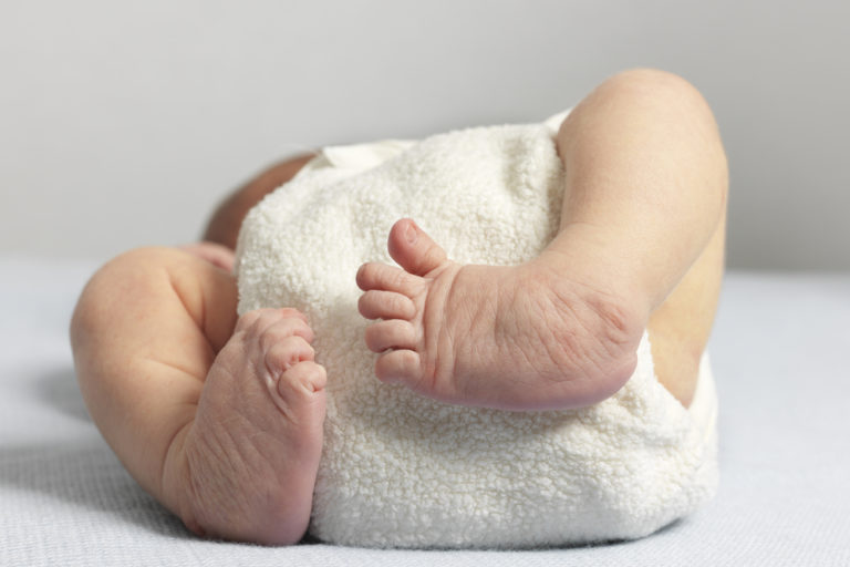 Photograph shows a newborn with bilateral club foot, also known as congenital talipes equinovarus