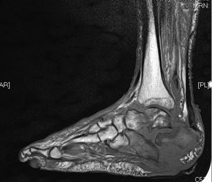An x-ray of the foot.