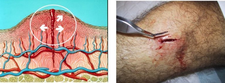 diagramatic representation of oedema and an image of oedema in a wound.