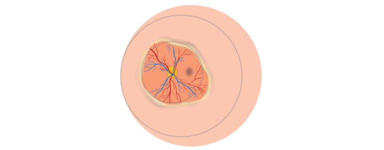Retinal illustration showing the main features of Zone I, stage 1 or 2 without plus disease ROP