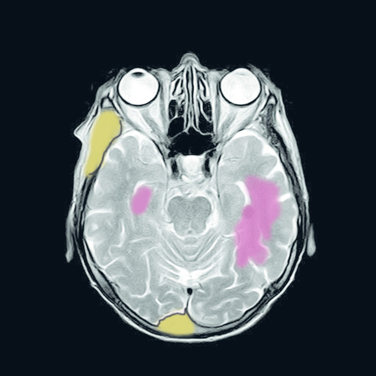 mri scan showing two tumour types