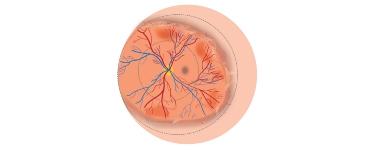 Retinal illustration showing the main features ofZone 2 Stage 3 without plus disease ROP