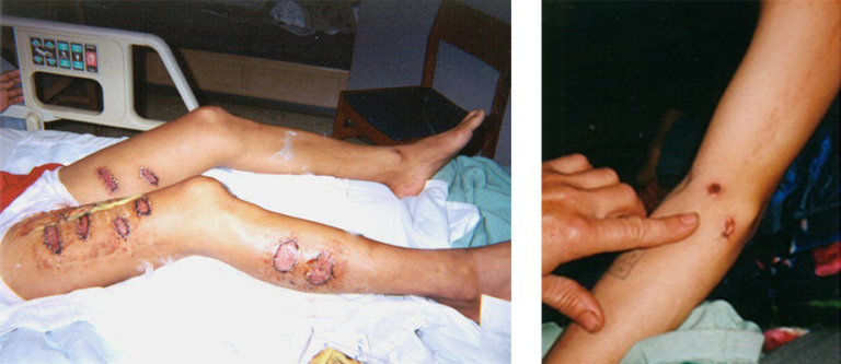 Left picture: Falun Gong practitioner with burns after being tortured by guards in a labor camp in the Boluo Area of China. Right picture: Skin marks after electrocution