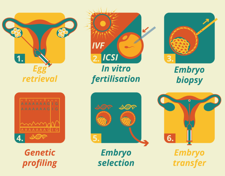 These are the key steps of PGD: 1. Egg retrieval 2. In vitro fertilisation 3. Embryo biopsy 4. Genetic profiling 5. Embryo selection 6. Embryo implantation