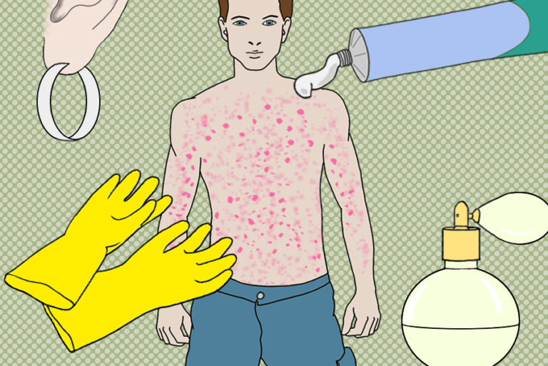 The illustration shows a human body covered with a skin rash as well as possible allergens that may have caused it; such as metals, fragrances, rubber chemicals, topical medication for example a cream.