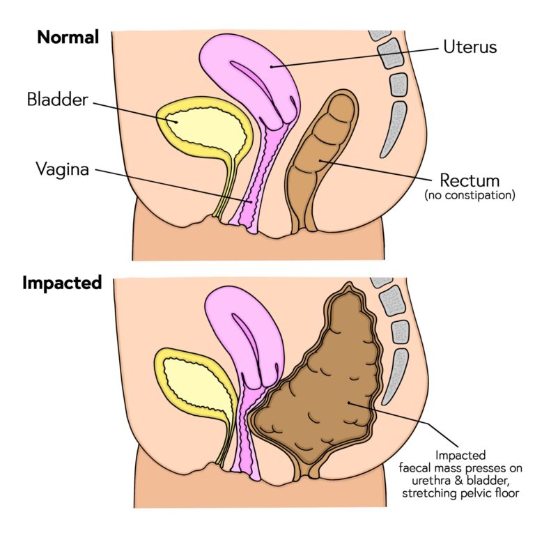 Comparison of normal bowel function with faecal impaction