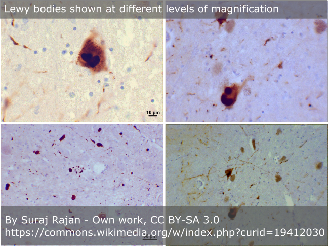 Image showing Lewy bodies at different levels of magnification