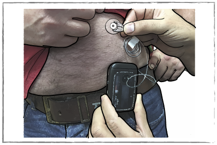 An insulin pump attached to a person's side and clipped on to their belt