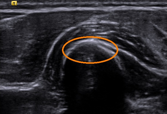 Ultrasound image with bone-muscle transition in orange circle