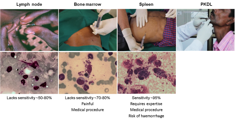 Panel of photos showing method of collection of biopsy samples from the spleen, bone marrow, lymph node or skin and the respective microscopic images of the samples stained with Giemsa for the identification of Leishmania amastigotes (LDUs).