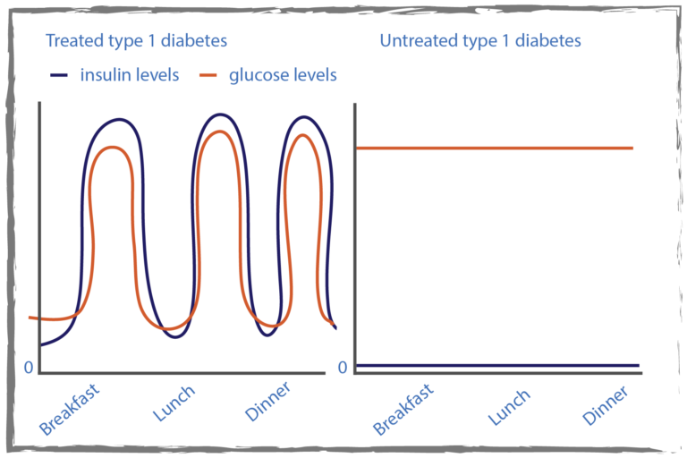 Graph of insulin and blood glucose levels during the day comparing treated type 1 diabetes where the insulin and glucose and insulin levels both dipping before breakfast, lunch and dinner and both rising after with untreated type 1 diabetes where the glucose level remains high and the insulin level stays at zero.