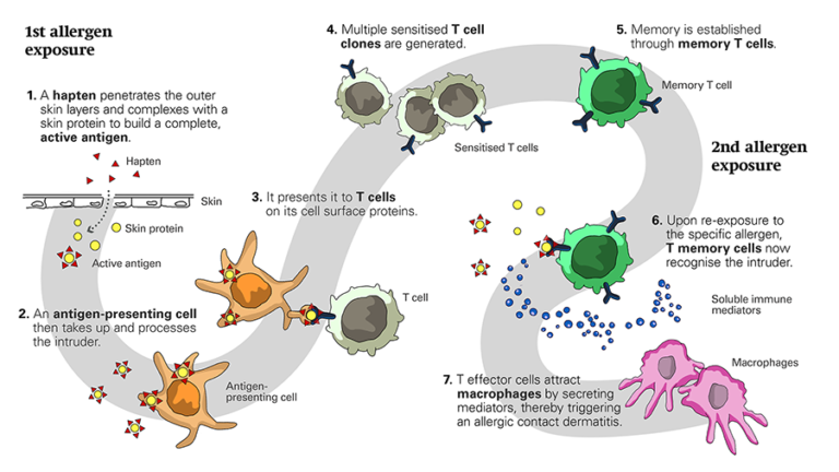 Illustration depicting the mechanisms of allergic contact dermatitis as described in the text below.