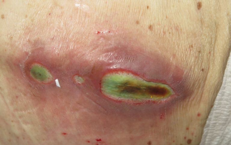 Pressure ulcer lumbar region displaying locoregional infection with Pseudomonas aeruginosa.