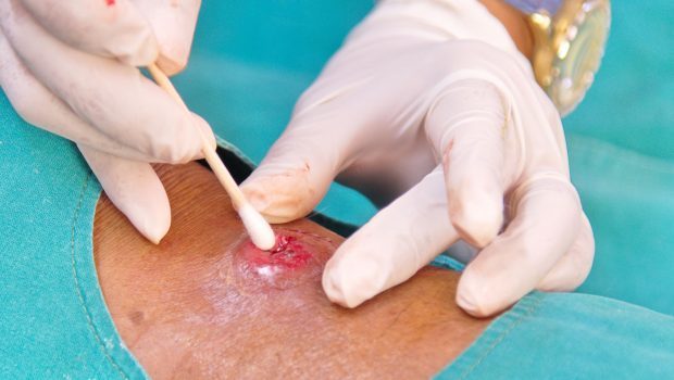 Image of a wound swab being taken.
