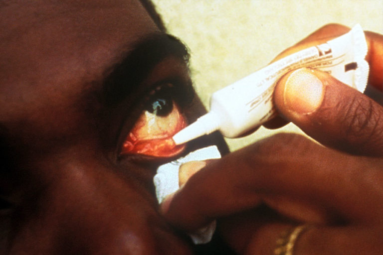 Applying eye ointment