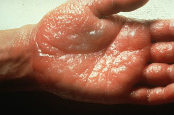 Photograph of a hand with typical manifestations of an allergic contact dermatitis.