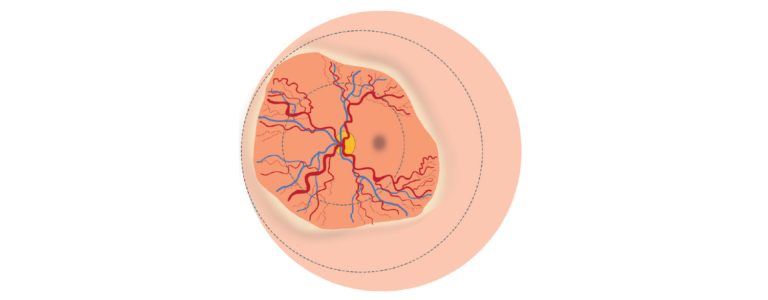 Illustration of the signs of plus disease in ROP as seen in the retina and described below