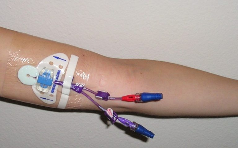 patient arm with intravenous catheter. Any intravenous catheter is a potential source of Candida infection