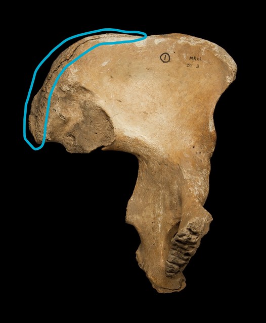 A pelvis with the fusion of the iliac crest epiphyses highlighted