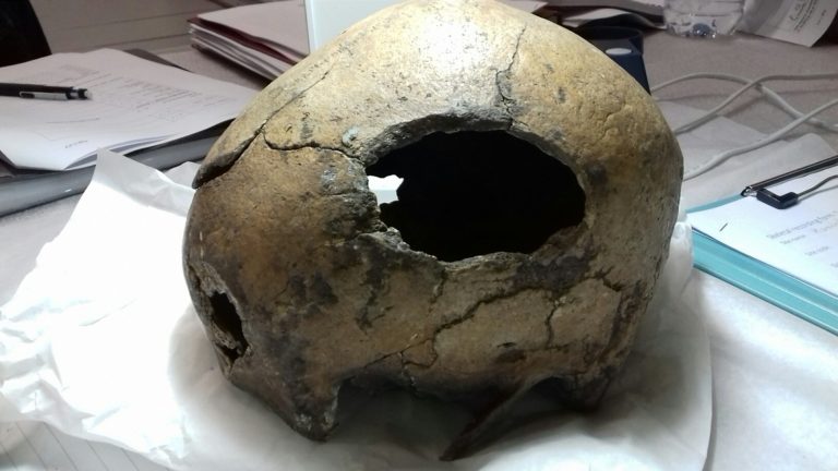 A large hole produced in the side of a skulls as the result of sharp force injury from a weapon such as a sword. This injury is consistent with the cause of death.