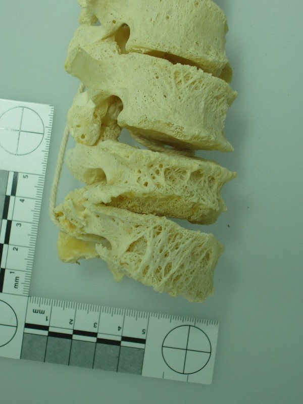 Vetrebrae with osteoporosis. Some of the vertebral bodies are compressed and show a loss of bone mass