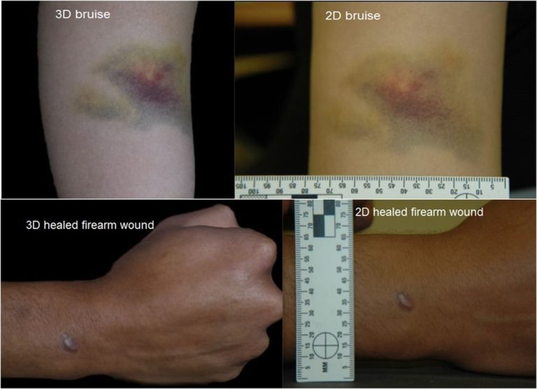 An image showing both two dimensional and three dimensional images of the same trauma on a living human. The first is bruising to the arm and the second is a healed injury from a firearm