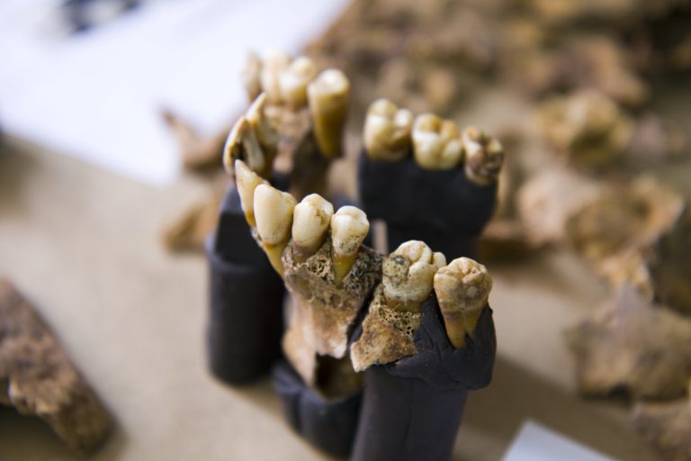 An upper jaw which has been embedded with teeth facing outwards in a black Plasticine type matrix to help hold the fragments together for ease of recording. This jaw is part of an individual recovered from a forensic context