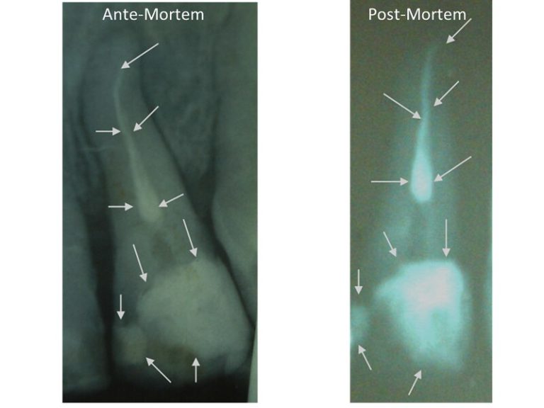 Two radiographs: The one on the left is an ante-mortem radiograph of a tooth and the one on the right was taken post-mortem. Arrows on both radiographs highlight similar features of dental fillings between the two on both the root and the crown