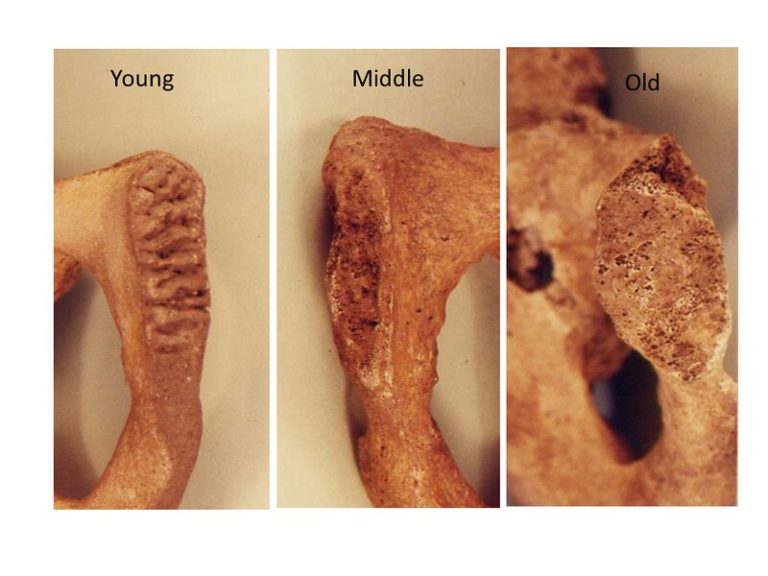 The Suchey-Brooks method for estimating age using the development