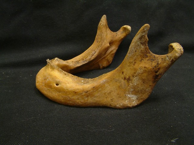 Numerous teeth in the lower jaw have been lost during life and the jaw has remodelled