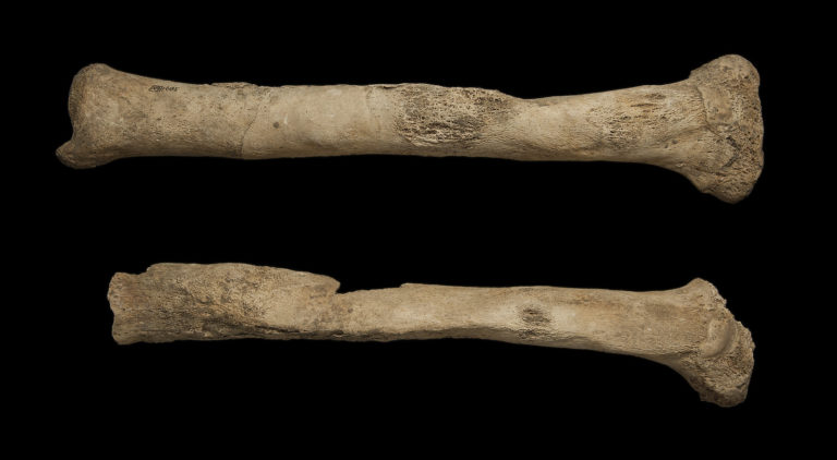 Right and left tibia showing an abnormally thickened appearance, along with new bone formation on the outer surface