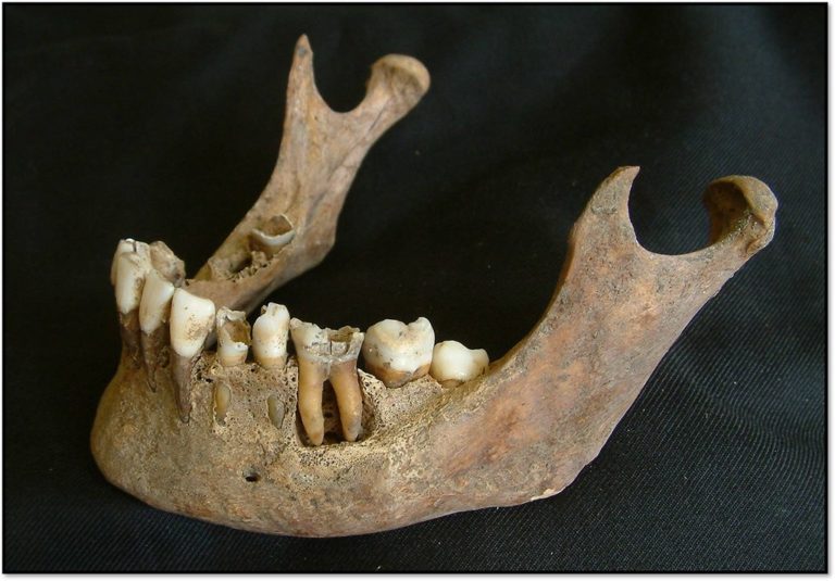 A jaw with a large rounded cavity beneath a tooth that has been affected by caries
