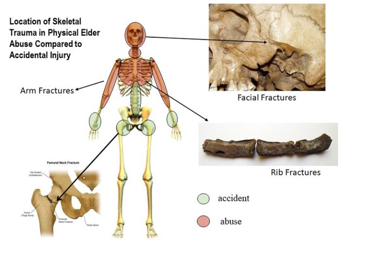 Pattern of injury expected in elder abuse compared to accidental injury. It present a skeleton chart showing the differences between the two and some photographs of rib fractures and facial fractures