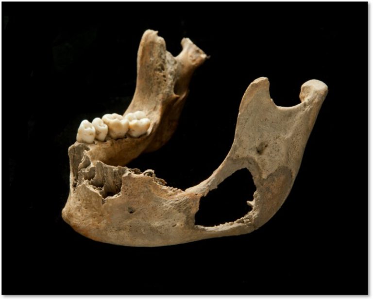 A large destructive hole in a jaw. The edges of the hole are quite sharp