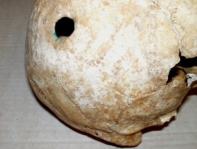 A skull with evidence of healed cranial surgery. You can see that the edges of the hole are rounded and remodelled which indicates healing. The greenish staining is from copper alloy placed over the hole