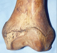 A knee in which the end of the bone (the epiphysis) has recently fused to the long bone shaft (diaphysis). The fusion line is still clearly visible