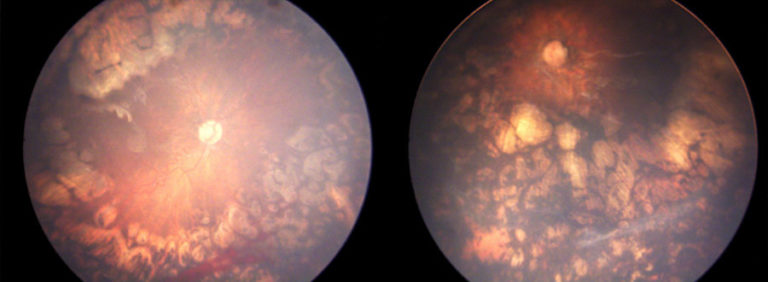 Retinal photographs of both eyes showing signs of laser treatment and disease regression