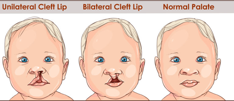 An illustration shows an example of a normal lip and a cleft lip