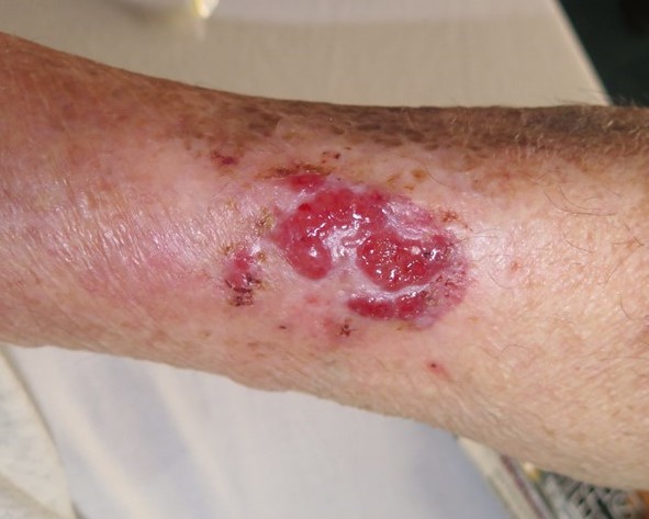 A follow up image of the wound, 2 months after initial consultation.