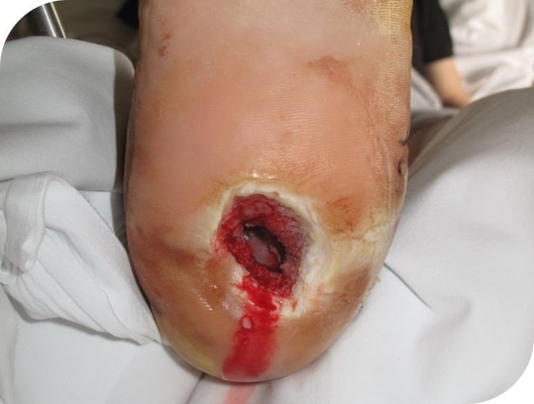 An image of the foot 1 week after starting NPWT treatment.