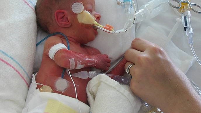 image of a neonate on a neonatal ICU, with multiple lines which can be a portal of entry for Candida