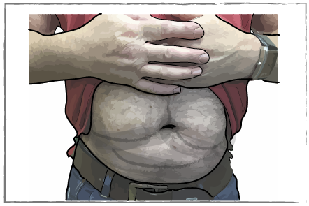 Man with exposed lumpy stomach area showing lipohypertrophy