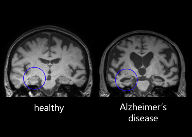 MRI scan of healthy brain compared with Alzheimer’s patient