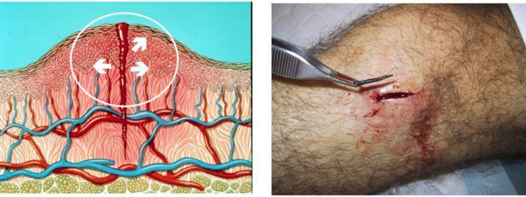 diagramatic representation of oedema and an image of oedema in a wound.